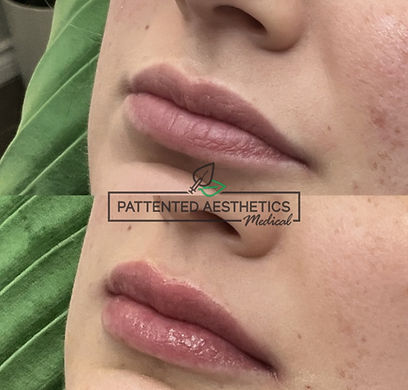Before and after lip enhancement using dermal filler at Pattented Aesthetics in Mississauga.
