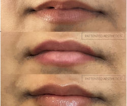 Lip Enhancement Before & After 3