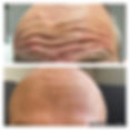 Before and after image of a Secret Faces Oakville male client’s forehead who received Dysport® treatment for wrinkles.
