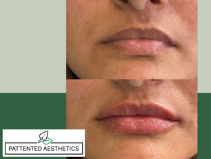 Before and after of lip enhancement done with dermal filler on a Pattented Aesthetics Mississauga client.