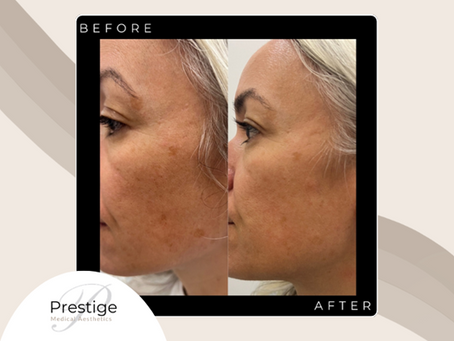 Before and after image of Prestige Medical Aesthetic client who recieved a Chemical Peel treatment at the clinic in Georgina.