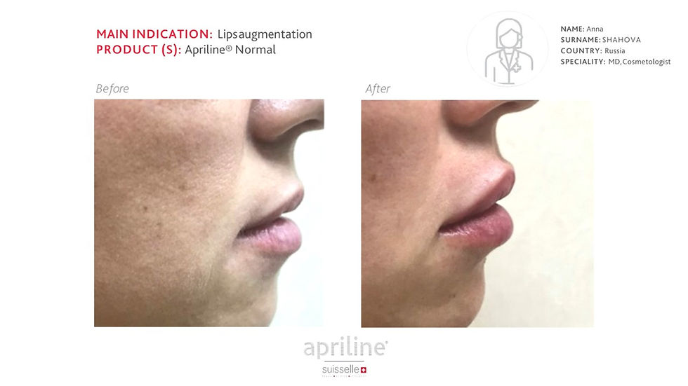 Lips augmentation_Apriline Normal_Dr.Shahova