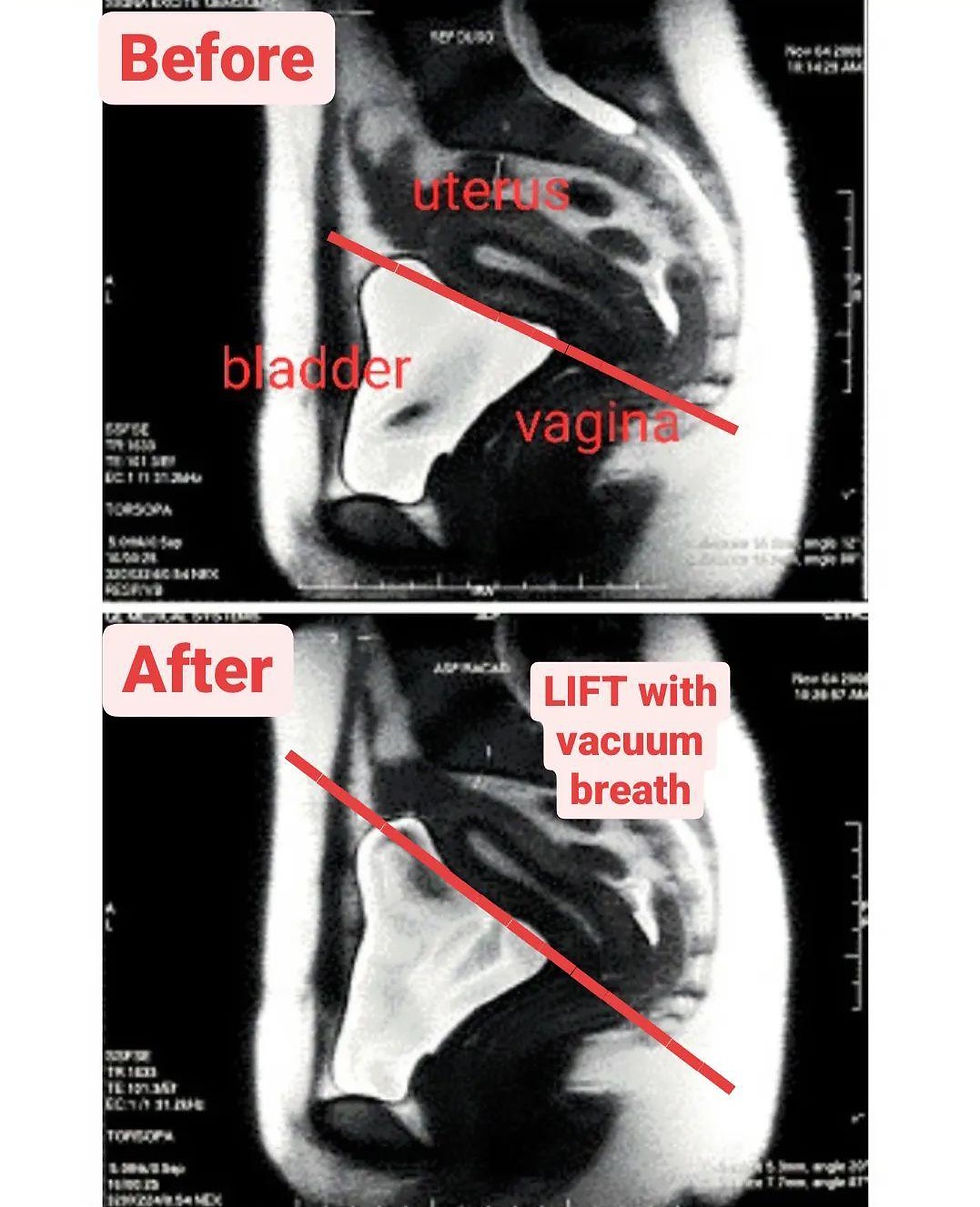 MRI showing pelvic organs lifting during a hypopressives vacuum breath. Latorre et al 2011 Research