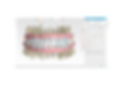 Simulation logicielle intermédiaire de correction orthodontique d'un jeune patient