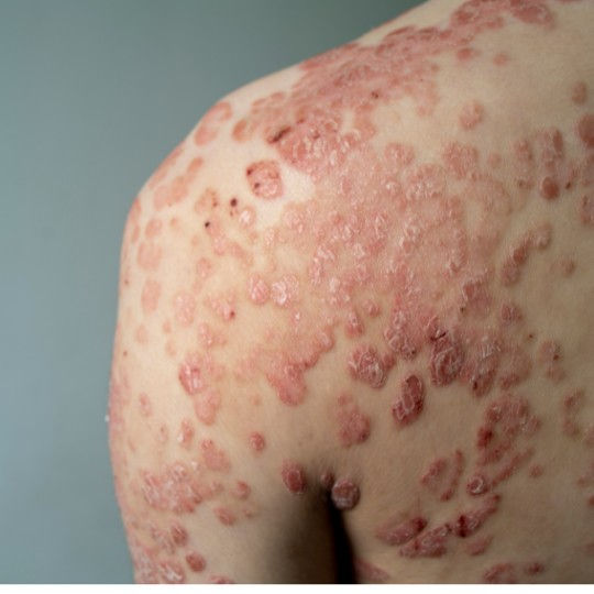 Psoriasis