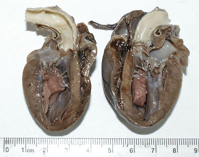 DM cardiomyopathy