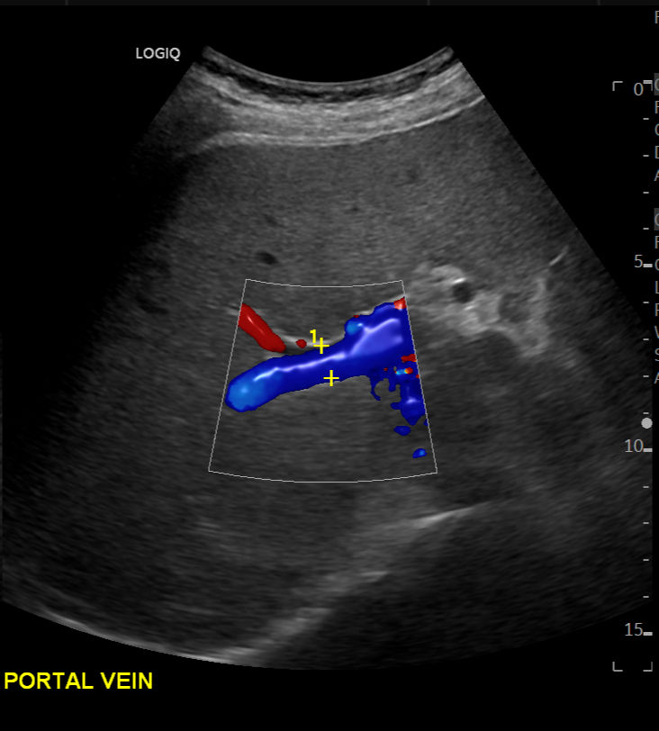 LIVER-RIGHT-PORTAL-VEIN-CF-WITH-RADIANTFLOW-C1-6-D_edited.jpg