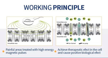 Extracorporeal magneto-transduction therapy (EMTT) and its contributary benefits with Radial ECSWT.