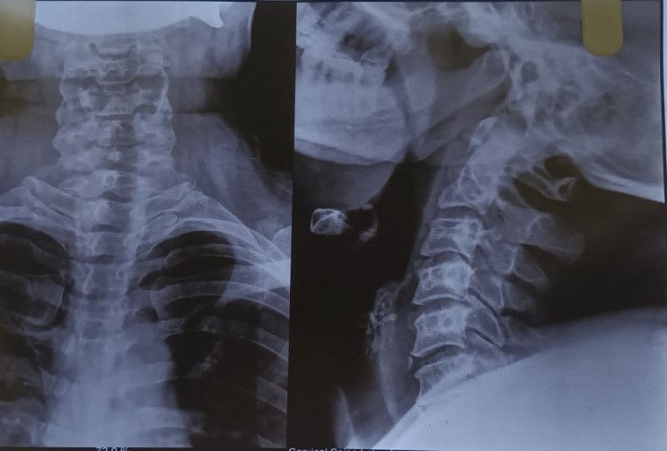 CERVICOGENIC VERTIGO