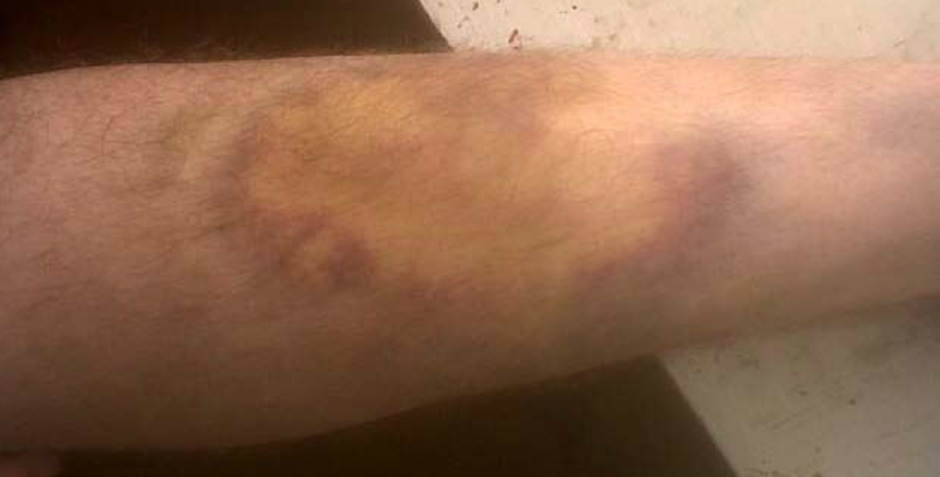 HEMATOMA