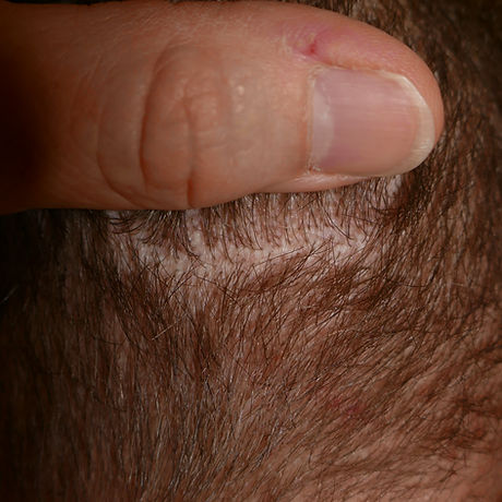 cicatrice trichophytique