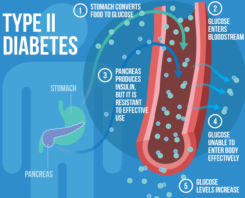 Type 2 diabetes infographic