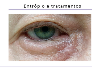 Entrópio e tratamentos com Jett Plasma Lift Medical com aplicador Oftalmológico
