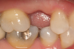 Missing Premolar