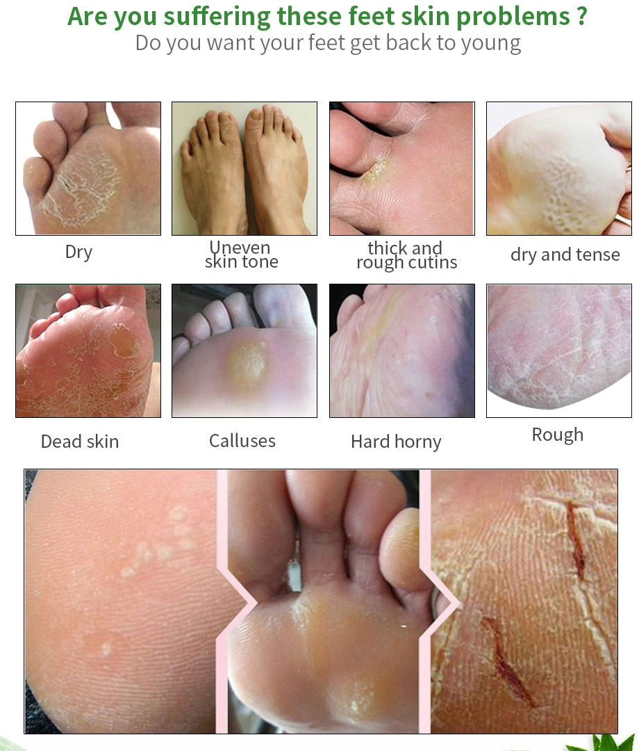 Thumbnail: Moisturizing Foot Mask for Exfoliation and Care