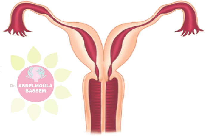 الرحم المزدوج (Didelphic Uterus)