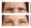 Frown Lines