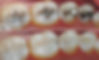 Tooth coloured fillings