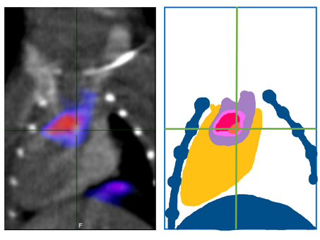 Studying mice to help prevent heart attacks and stroke