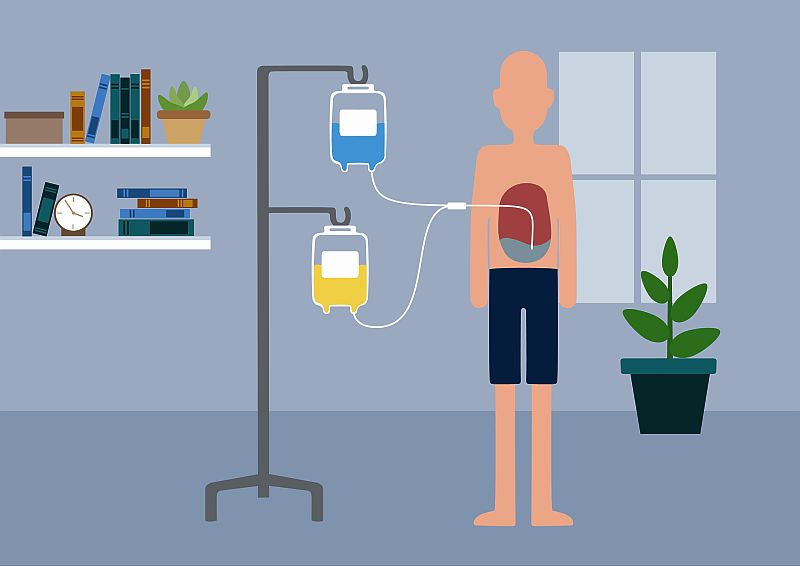 Peritonealdialyse (Bild: UKSH)