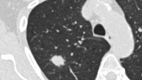Früherkennung von Lungenkrebs: Zusätzliche Kriterien könnten mehr Fälle aufdecken