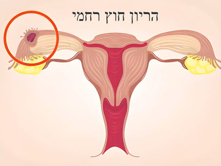 Diagram of the female reproductive system highlighting an ectopic pregnancy in the fallopian tube. Hebrew text at the top.