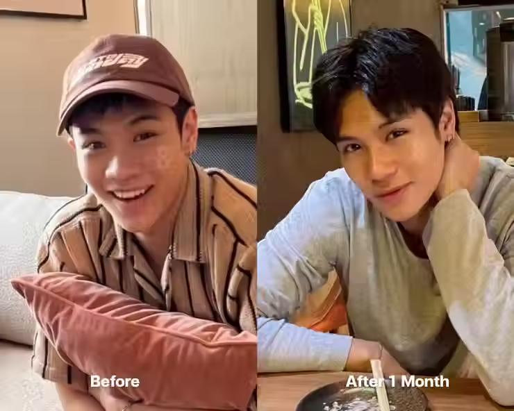 Mississobeauty เอเจนซี่ศัลยกรรมเกาหลี เสริมจมูกผู้ชาย ที่ Eight Plastic Surgury