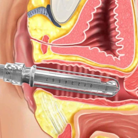 Laser vaginal na menopausa: quando é indicado e como funciona