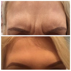 Anti Wrinkle Injections