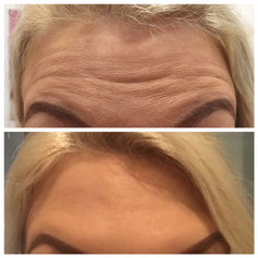 Anti Wrinkle Injections