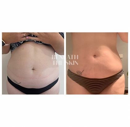 Fat Dissolving- Stomach