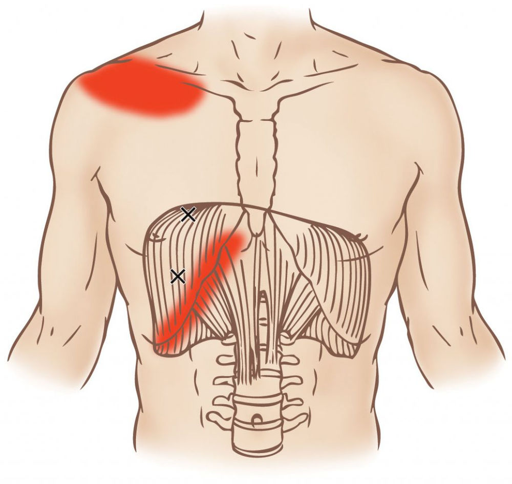 Abdominal Trigger Points and Shoulder Pain