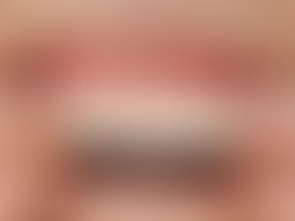 Why Do My Dentures Hurt My Gums?