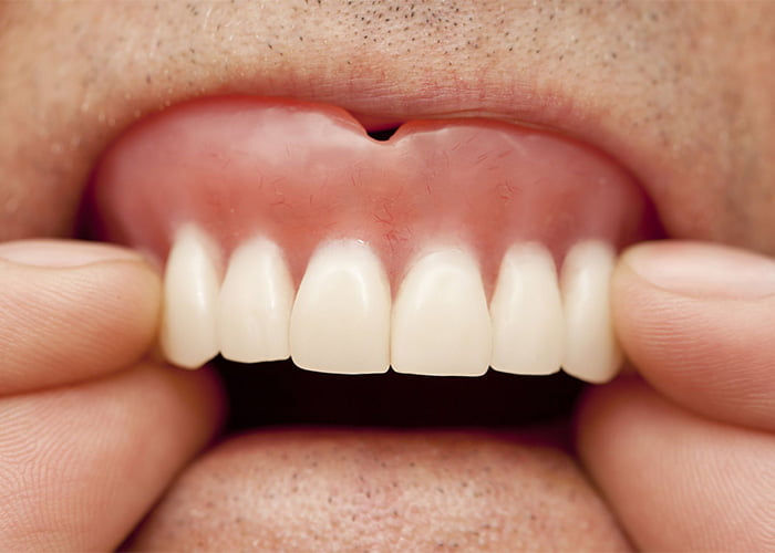 Why Do My Dentures Hurt My Gums?