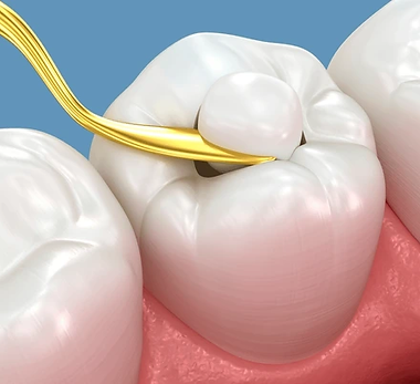dental composite filling