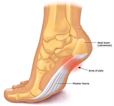 Can Massage Help My Plantar Fasciitis