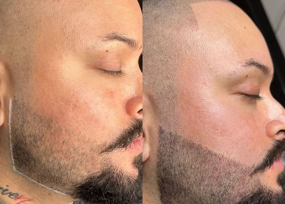 Avant après tricopigmentation de barbe guebwiller