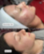 Acne Bootcamp 1004