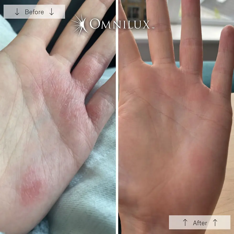 Thumbnail: Omnilux Contour Glove