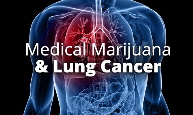 Cannabidiol (CBD) May Increase Lung Cancer’s Susceptibility To Specialized Killer Cells