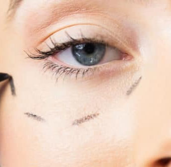 Les poches malaires, un œdème ou un gonflement situé sur la partie haute de la pommette