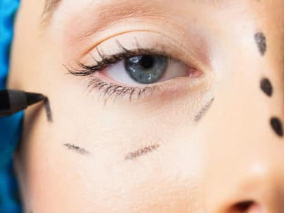 Les poches malaires, un œdème ou un gonflement situé sur la partie haute de la pommette