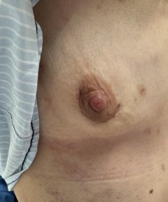 chirurgie cardiaque mini-invasive ccvb