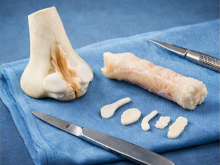 Greffons cartilagineux en rhinoplastie : d’où viennent-ils et pourquoi sont-ils essentiels ?