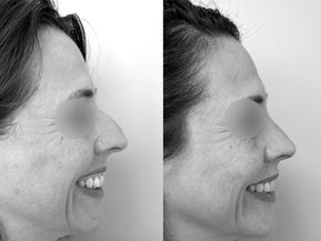 avant après rhinoplastie