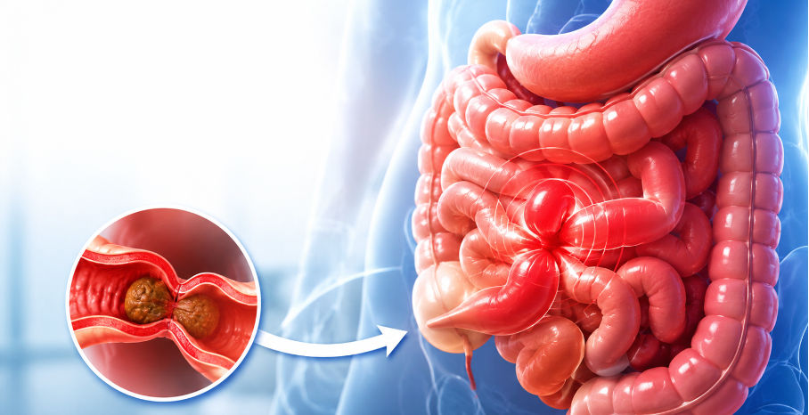xOcclusion intestinale : quand faut-il consulter avant qu’il ne soit trop tard ?