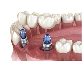 Implantologie : une prise en charge multidisciplinaire