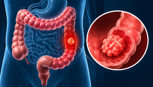 Cancer colorectal : quelle place pour la chirurgie digestive ?