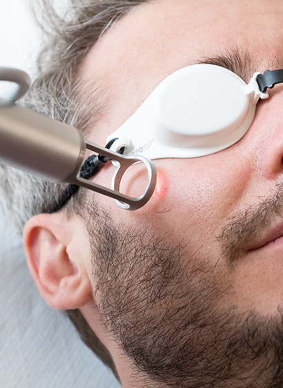 laser CO2 homme montpellier