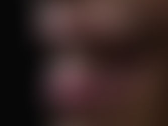 La mise en esthétique immédiate en implantologie dentaire